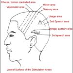 Lateral Surface of the Stimulation Areas - a diagram of head showing areas of acupuncture stimulation for stress relief