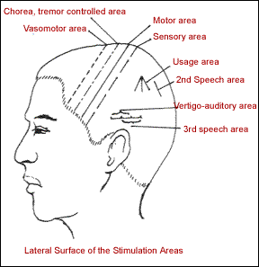 Lateral Surface of the Stimulation Areas - a diagram of head showing areas of acupuncture stimulation for stress relief