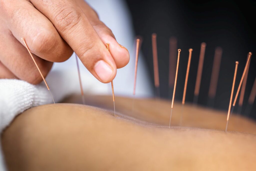 women's back receiving acupuncture with steel needles.