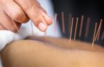 women's back receiving acupuncture with steel needles.