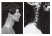 mans neck and xray of neck showing good posture after massage